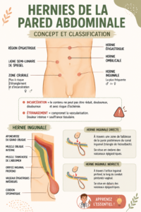 Illustration représentant les différents types de hernies abdominales